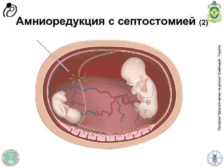 Програма доров'я матері та дитини” Швейцарія - Україна Програма “Здоров'я матері та дитини” Швейцарія