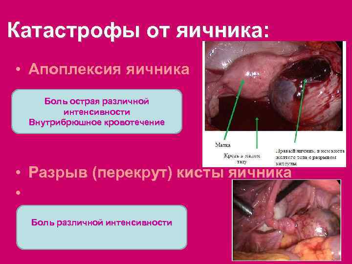 Катастрофы от яичника: • Апоплексия яичника Боль острая различной интенсивности Внутрибрюшное кровотечение • Разрыв