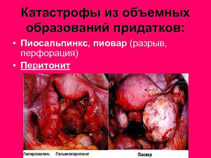 Катастрофы из объемных образований придатков: • Пиосальпинкс, пиовар (разрыв, перфорация) • Перитонит 