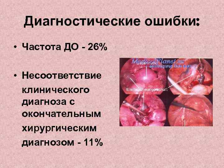 Диагностические ошибки: • Частота ДО - 26% • Несоответствие клинического диагноза с окончательным хирургическим