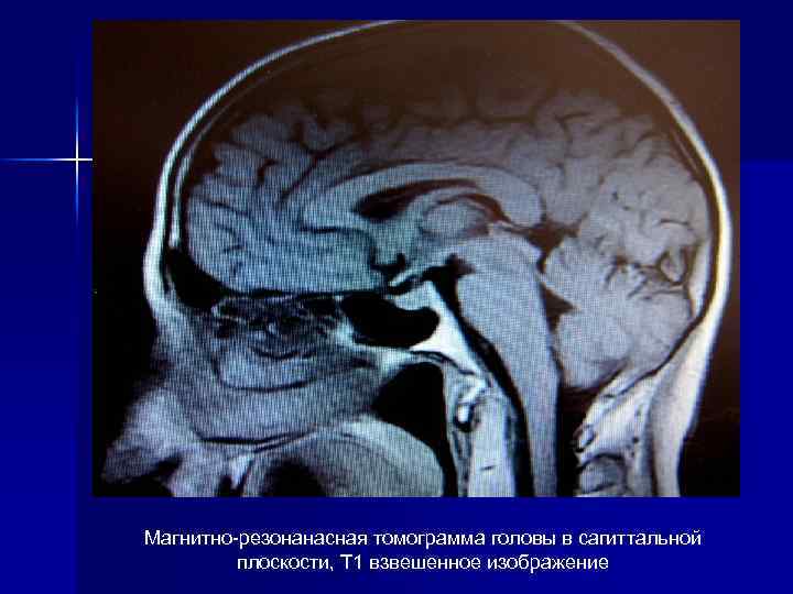 Магнитно-резонанасная томограмма головы в сагиттальной плоскости, Т 1 взвешенное изображение 
