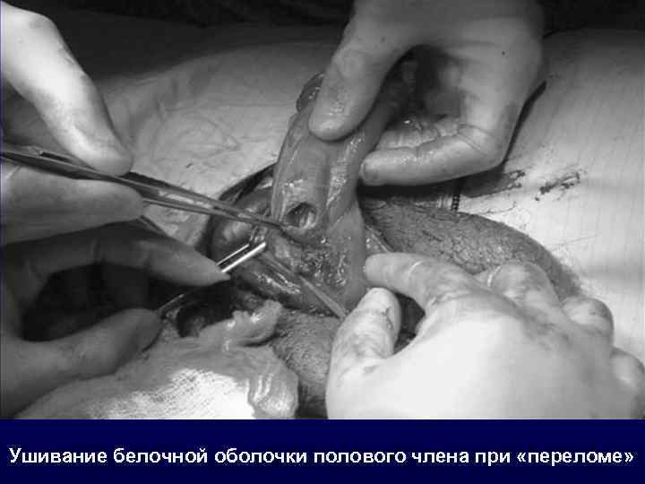 Ушивание белочной оболочки полового члена при «переломе» 
