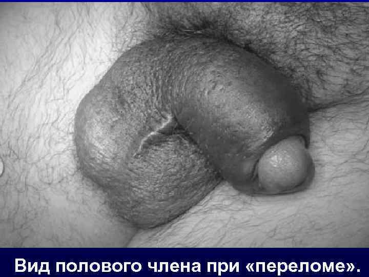 Вид полового члена при «переломе» . 