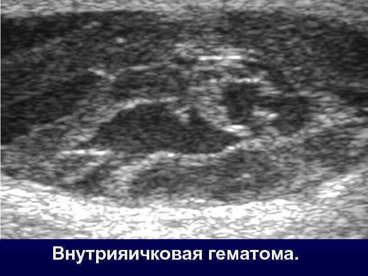 Внутрияичковая гематома. 