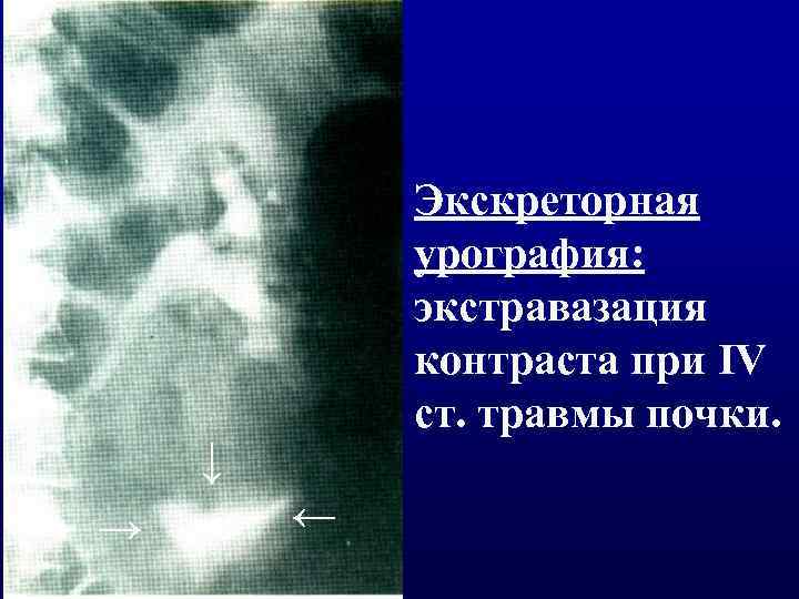 Экскреторная урография: экстравазация контраста при IV ст. травмы почки. ↑ ↑ ↑ 