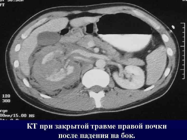 КТ при закрытой травме правой почки после падения на бок. 