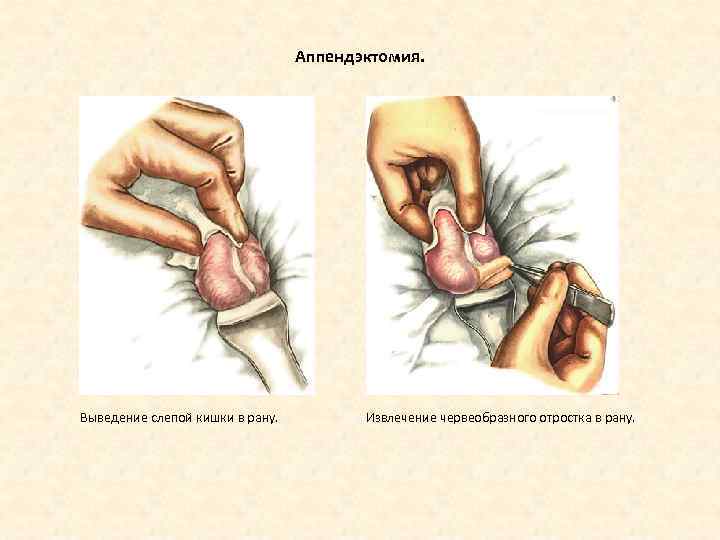 Аппендэктомия. Выведение слепой кишки в рану. Извлечение червеобразного отростка в рану. 