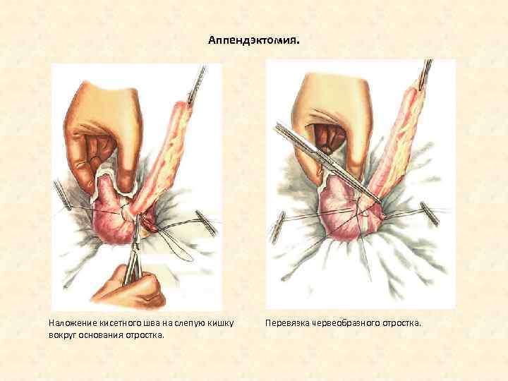Аппендэктомия. Наложение кисетного шва на слепую кишку вокруг основания отростка. Перевязка червеобразного отростка. 