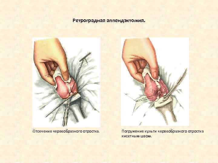 Ретроградная аппендэктомия. Отсечение червеобразного отростка. Погружение культи червеобразного отростка кисетным швом. 