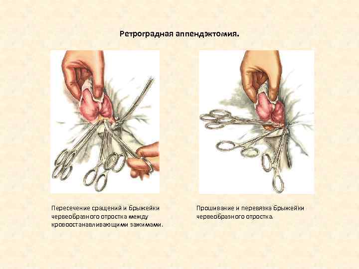 Ретроградная аппендэктомия. Пересечение сращений и брыжейки червеобразного отростка между кровоостанавливающими зажимами. Прошивание и перевязка