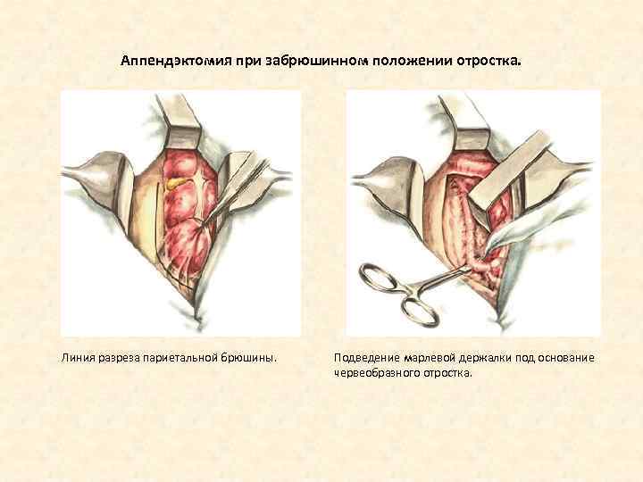 Аппендэктомия при забрюшинном положении отростка. Линия разреза париетальной брюшины. Подведение марлевой держалки под основание