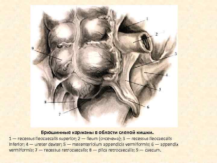 Брюшинные карманы в области слепой кишки. 1 — recessus ileocaecalis superior; 2 — ileum