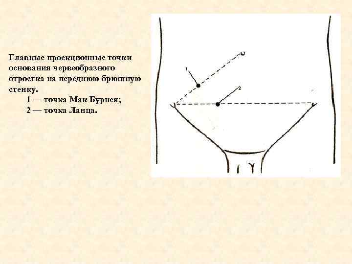 Главные проекционные точки основания червеобразного отростка на переднюю брюшную стенку. 1 — точка Мак