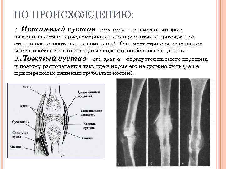 ПО ПРОИСХОЖДЕНИЮ: 1. Истинный сустав – art. vera – это сустав, который закладывается в