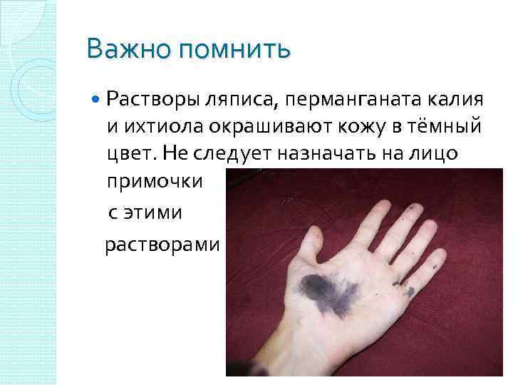 Важно помнить Растворы ляписа, перманганата калия и ихтиола окрашивают кожу в тёмный цвет. Не