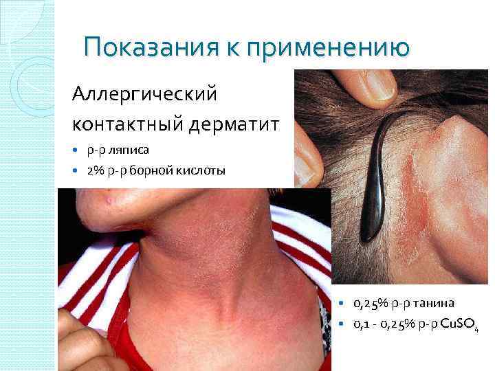 Показания к применению Аллергический контактный дерматит р-р ляписа 2% р-р борной кислоты 0, 25%