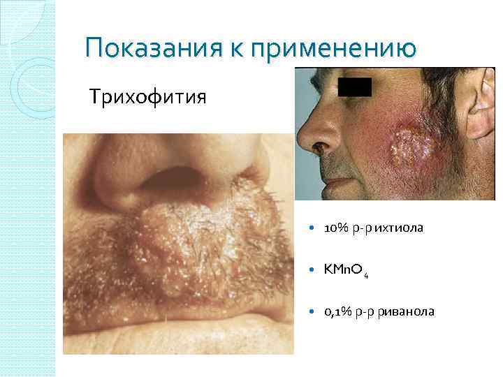 Показания к применению Трихофития 10% р-р ихтиола KMn. O 4 0, 1% р-р риванола