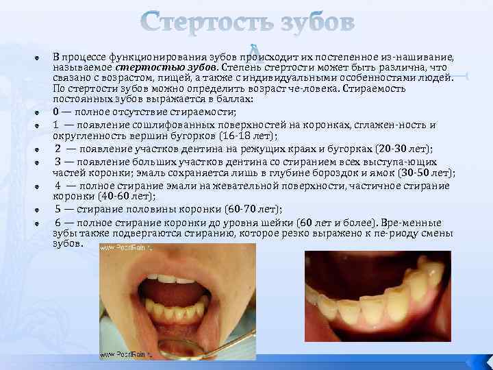  Стертость зубов В процессе функционирования зубов происходит их постепенное из нашивание, называемое стертостью