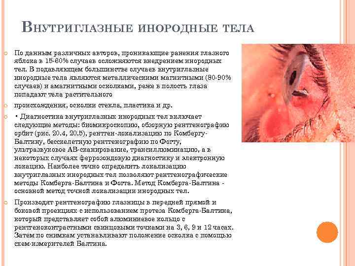 ВНУТРИГЛАЗНЫЕ ИНОРОДНЫЕ ТЕЛА По данным различных авторов, проникающие ранения глазного яблока в 15 -60%