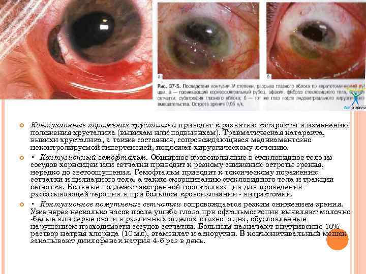  Контузионные поражения хрусталика приводят к развитию катаракты и изменению положения хрусталика (вывихам или
