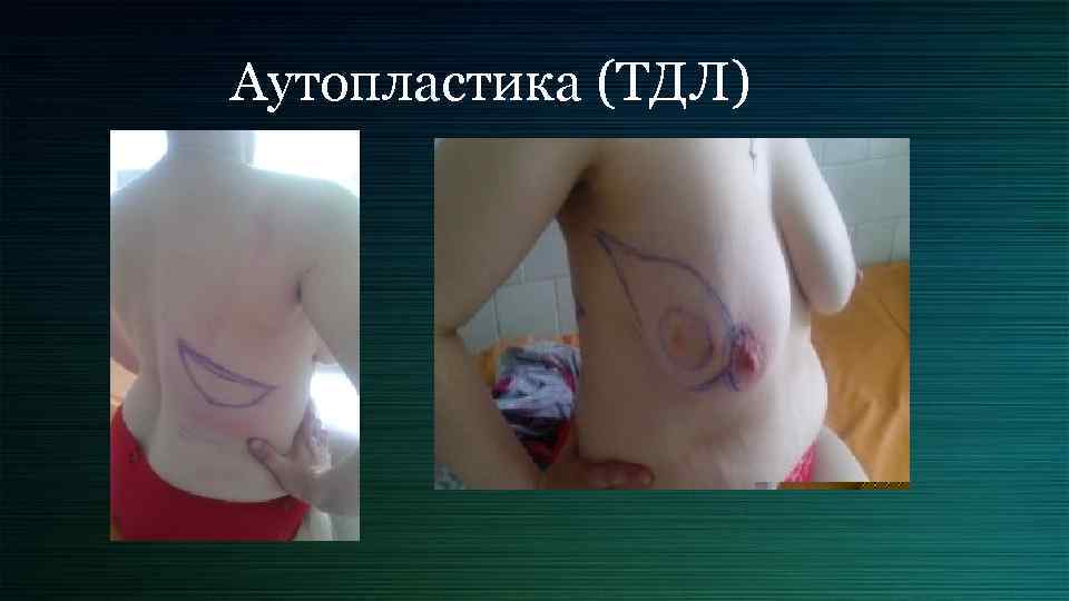 Аутопластика (ТДЛ) 