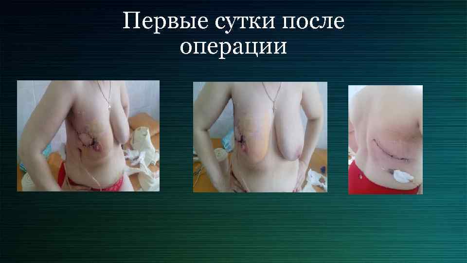 Первые сутки после операции 