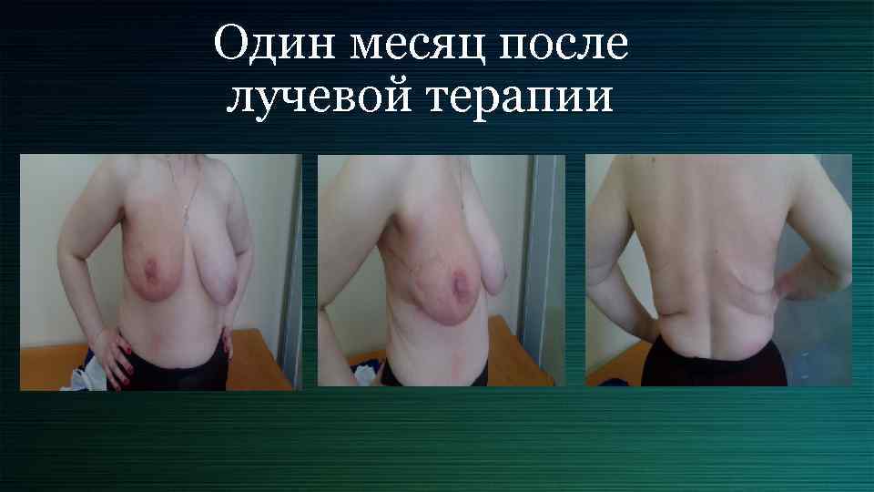Один месяц после лучевой терапии 
