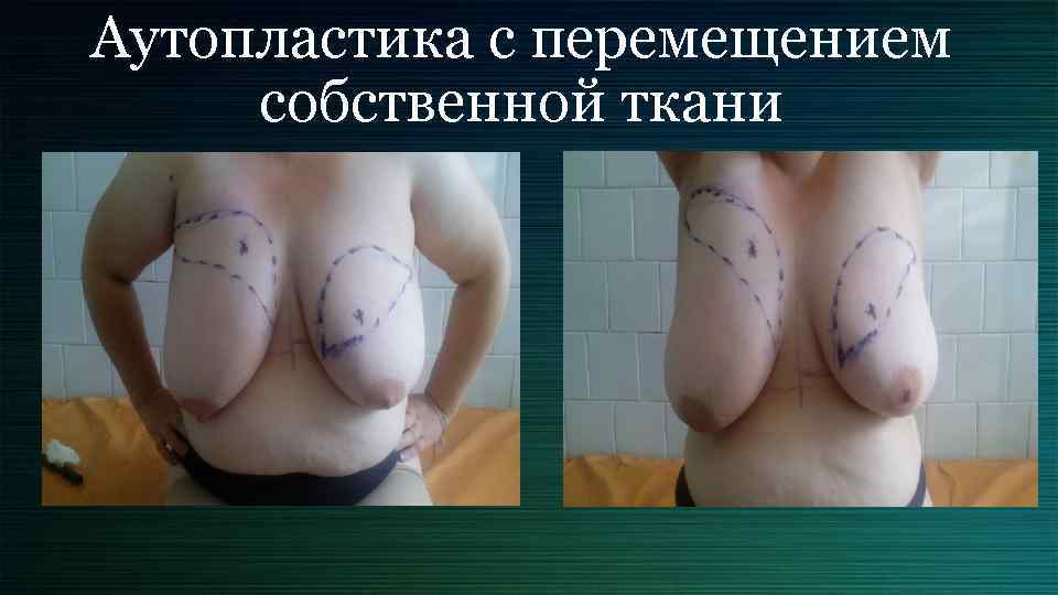 Аутопластика с перемещением собственной ткани 