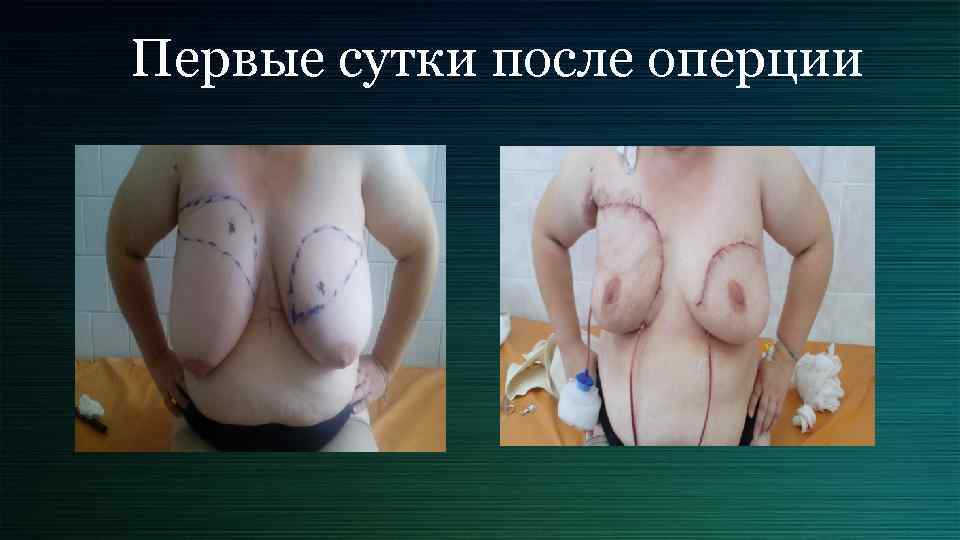 Первые сутки после оперции 