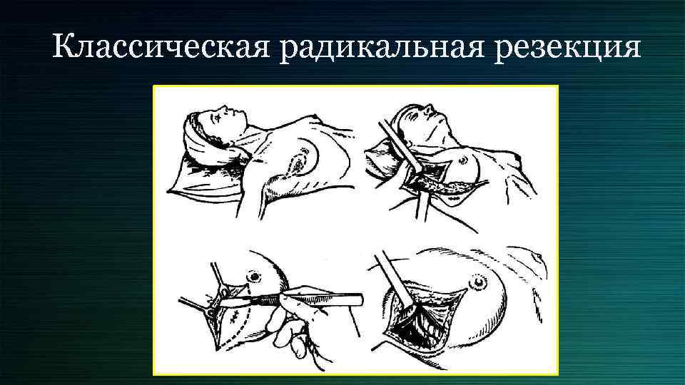 Классическая радикальная резекция 