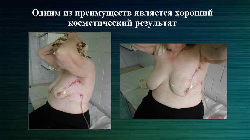 Одним из преимуществ является хороший косметический результат 