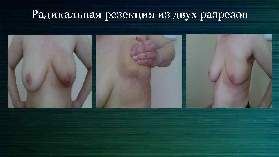 Радикальная резекция из двух разрезов 