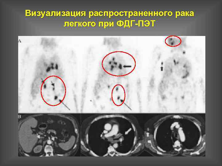 Визуализация распространенного рака легкого при ФДГ-ПЭТ 