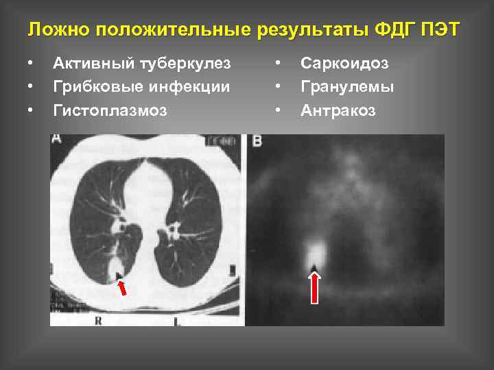 Ложно положительные результаты ФДГ ПЭТ • • • Активный туберкулез Грибковые инфекции Гистоплазмоз •