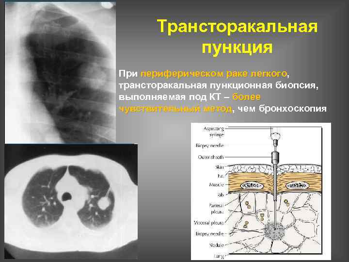 Трансторакальная пункция При периферическом раке легкого, легкого трансторакальная пункционная биопсия, выполняемая под КТ –