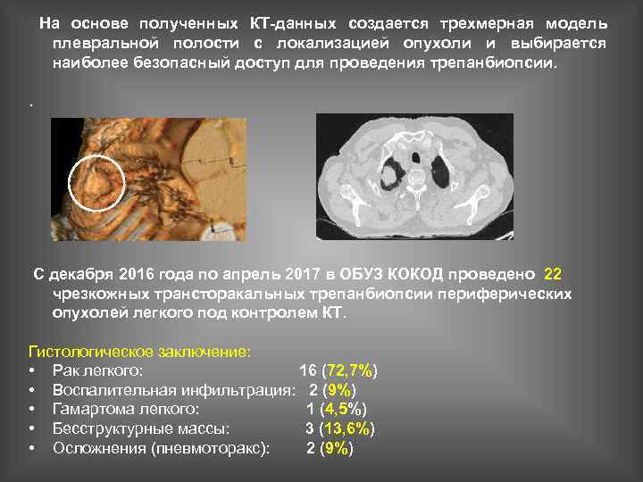 На основе полученных КТ-данных создается трехмерная модель плевральной полости с локализацией опухоли и выбирается