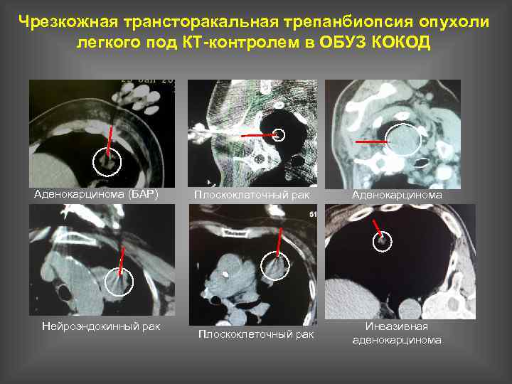 Чрезкожная трансторакальная трепанбиопсия опухоли легкого под КТ-контролем в ОБУЗ КОКОД Аденокарцинома (БАР) Нейроэндокинный рак