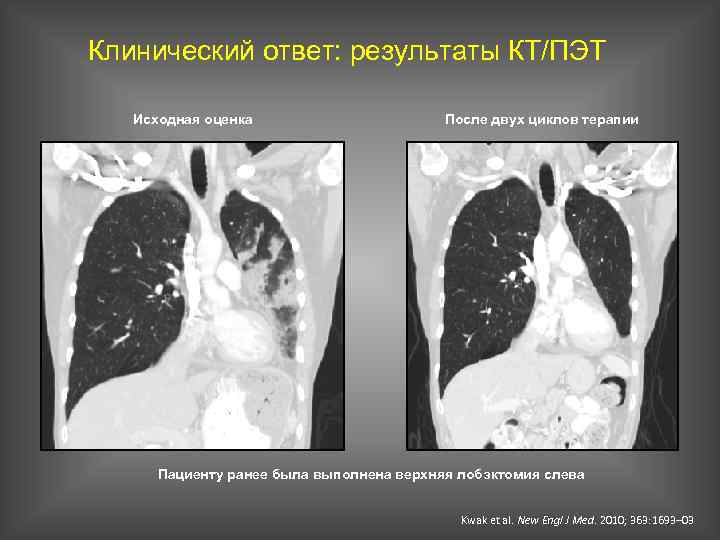 Клинический ответ: результаты КТ/ПЭТ Исходная оценка После двух циклов терапии Пациенту ранее была выполнена