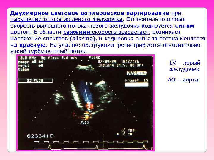 Двухмерное цветовое доплеровское картирование при нарушении оттока из левого желудочка. Относительно низкая скорость выходного