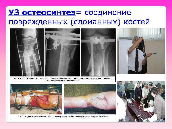 УЗ остеосинтез= соединение поврежденных (сломанных) костей 