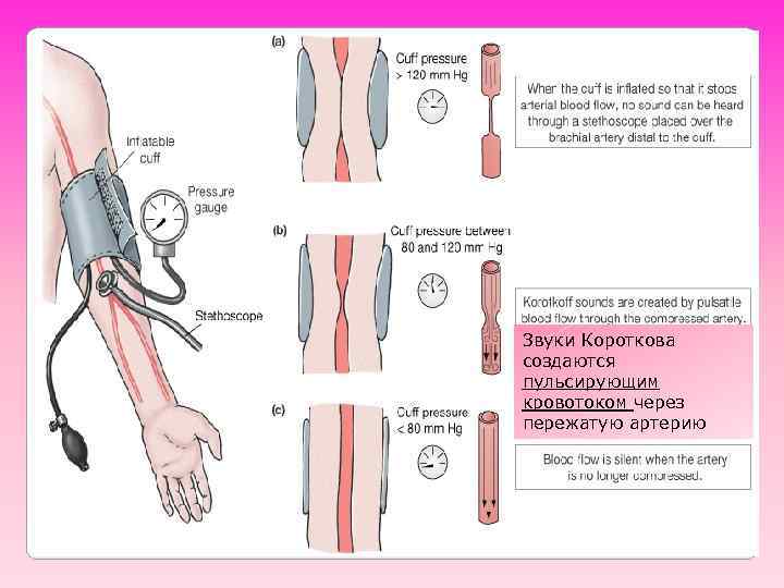 Звуки Короткова создаются пульсирующим кровотоком через пережатую артерию 