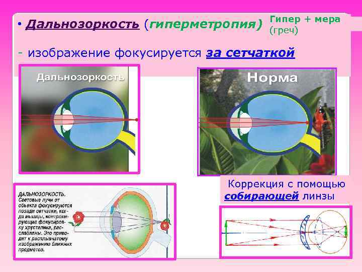  • Дальнозоркость (гиперметропия) Гипер + мера (греч) - изображение фокусируется за сетчаткой Коррекция