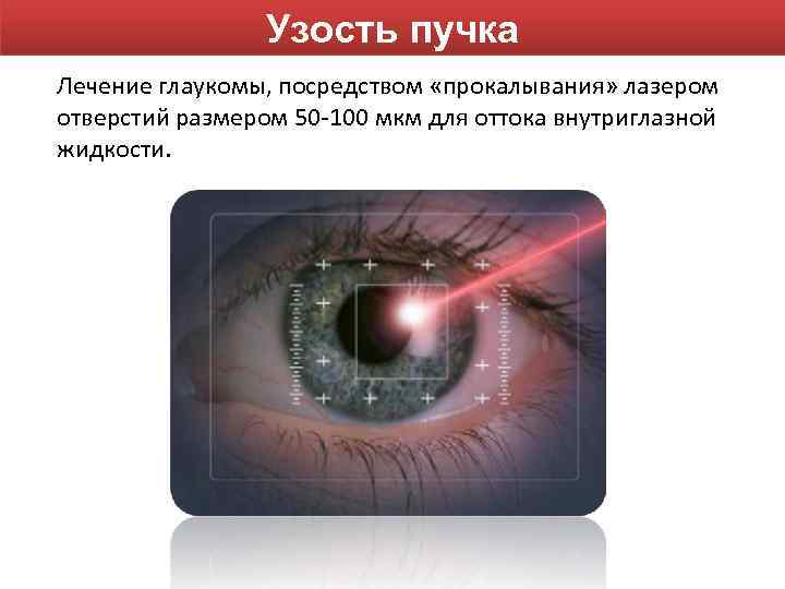 Узость пучка Лечение глаукомы, посредством «прокалывания» лазером отверстий размером 50 -100 мкм для оттока