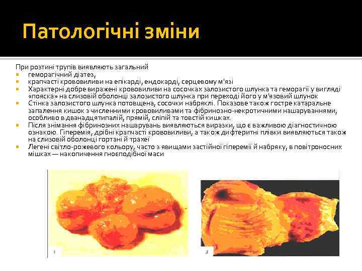 Патологічні зміни При розтині трупів виявляють загальний геморагічний діатез, крапчасті крововиливи на епікарді, ендокарді,