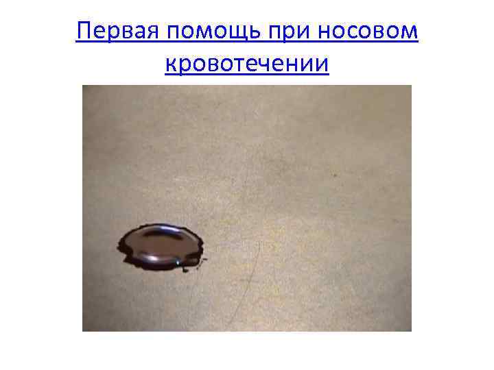 Первая помощь при носовом кровотечении 