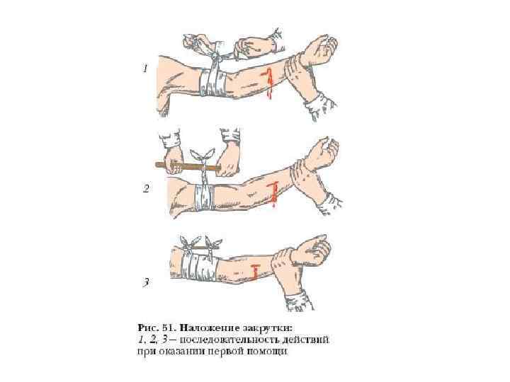 Картинка первая помощь при венозном кровотечении