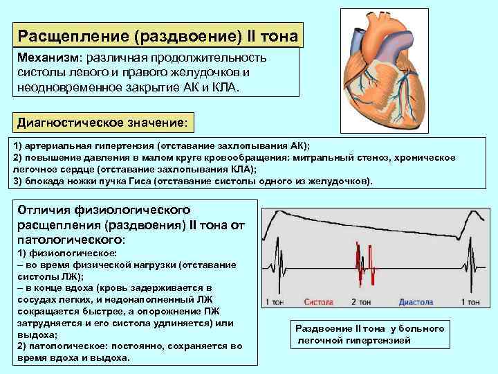 Расщепление (раздвоение) II тона Механизм: различная продолжительность систолы левого и правого желудочков и неодновременное