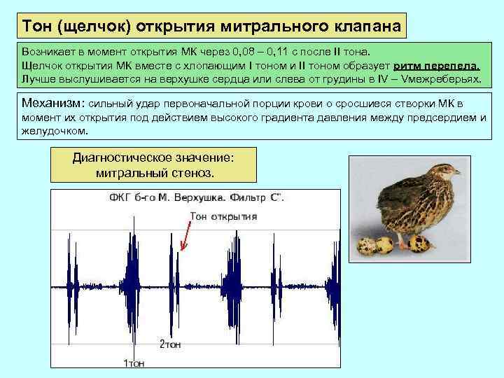 Тон (щелчок) открытия митрального клапана Возникает в момент открытия МК через 0, 08 –