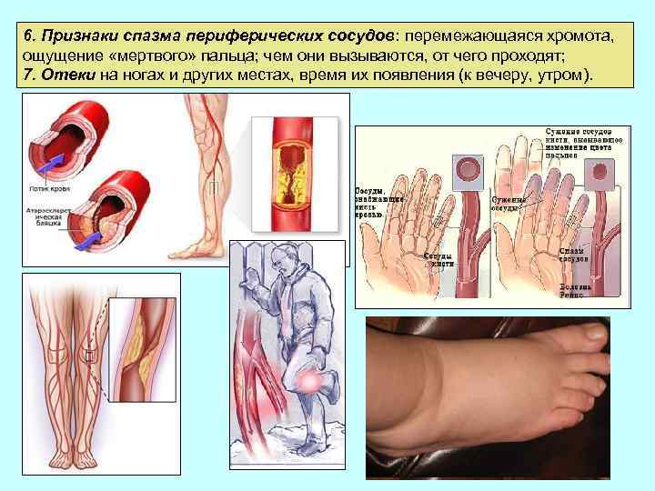 6. Признаки спазма периферических сосудов: перемежающаяся хромота, ощущение «мертвого» пальца; чем они вызываются, от