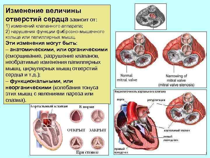 Изменение величины отверстий сердца зависит от: 1) изменений клапанного аппарата; 2) нарушения функции фиброзно-мышечного